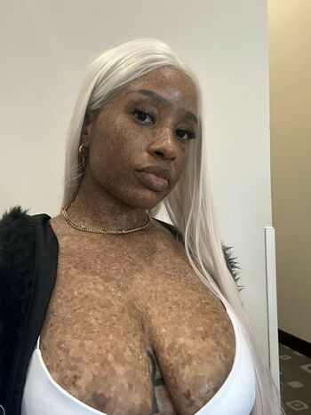 freckledn